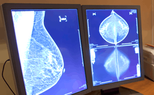 Современные методы лечения рака молочной железы
